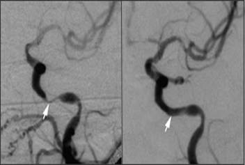 Cerebral Angioplasty Surgery India Offers info on Angioplasty Of Cerebral India, Stenting Of Carotid India