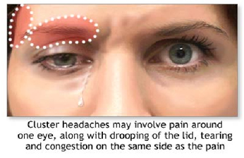 Cluster Headache Surgery India Offers info on Cluster Headache Surgery India, India Cluster India