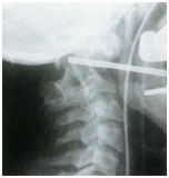 Anterior Transoral Approach, Spine Care India, Upper Cervical Spine