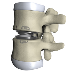 Artificial Disc Replacement India, Artificial Disk, Spine, India Hospital Tour