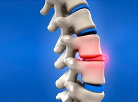 Herniated Disc Surgery India, Herniated Disc Replacement Surgery India