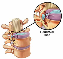 Herniated Disc Surgery India, Herniated Disc, Herniated Disc Surgery Abroad, Herniated Disc Surgery Mumbai