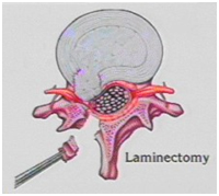 Lumbar Discectomy, Discectomy Surgery, Microlumbar Discectomy