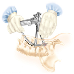 Posterior Lumbar Interbody Fusion Surgery, Surgery, Surgeon