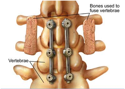 Spinal Fusion, Spinal Fusion Surgery, Chronic Back Pain, Back Pain Treatment, Healthcare Procedures