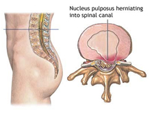 Spinal Stenosis Surgery, Spinal Stenosis Surgery, Cervical Stenosis