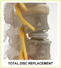 Total Disc Replacement, Disc Replacement Surgery, Spinal Fusion