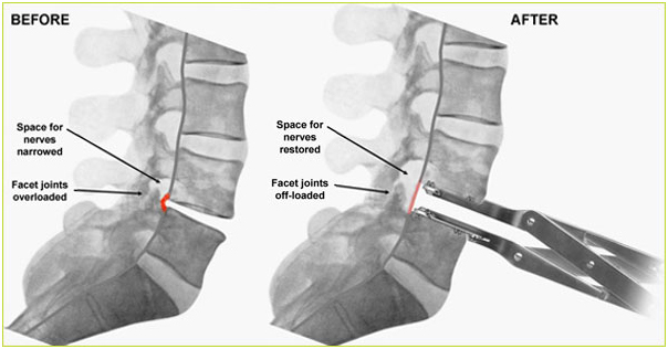 Disc Replacement Surgery, Spinal Fusion, Clinical Trial