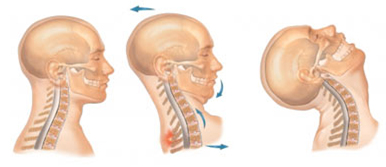 Whiplash Surgery, Whiplash Surgery India, Whiplash, Surgery, Discectomy, Fusion, Recovery