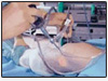 low cost surgery Bangalore, hip replacement,  knee replacement, spine surgery