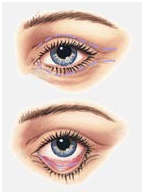 Eye Lid Surgery India, Blepharoplasty, Eye Lid Surgery, Blepharoplasty India, India Eye Lid