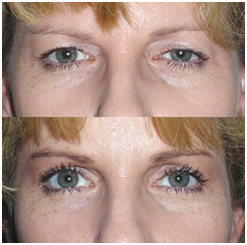 Eye Lid Surgery, Blepharoplasty India, Blepharoplasty Recovery