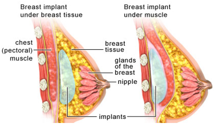 Breast Augmentation Surgery India, Breast Lift Raises India, Breast Augmentation Surgery India