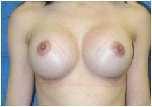 Breast Implant India, Breast Enlargement