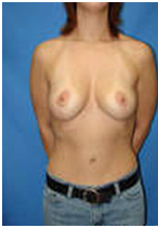 Breast Lift Surgery India, Breast Lift India, Breast, Breast Lift Surgery In India