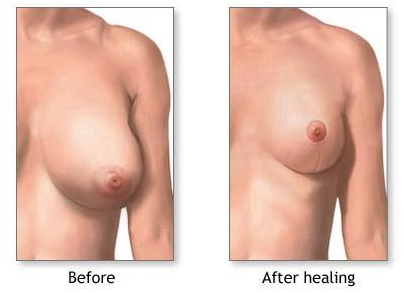 Reduction Mammaplasty India, Breast Reduction abroad, Breast, India Hospital Tour