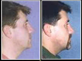 Chin And Cheek Augmentation Surgery, Cheek Augmentation Surgery India, Chin Implants