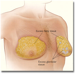 Gynaecomastia India, Gyno Surgery India, Breast, Breast Tissue, Common Disorder Of The Male Breast