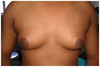 Gynaecomastia India, Gyno Surgery India, Breast, Breast Tissue, Common Disorder Of The Male Breast