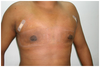 Gyno Surgery India, Breast, Breast Tissue, Common Disorder Of The Male Breast, Gynaecomastia Surgery India