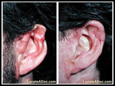 Otoplasty, Ear Surgery, Otoplasty Ear India, Ear Surgery India, Otoplasty India