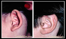 Otoplasty Ear India, Ear Surgery India, Otoplasty India, Otoplasty Ear Surgery