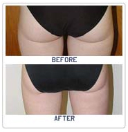 Thigh Lift Cosmetic Surgery India, Body Lift India, Before And After Thigh Lift Surgery Pictures