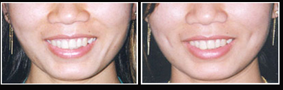 Dimple Surgery, Cheek Dimple Creation, Dimple Plastic Surgery, Face Dimples