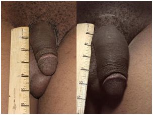 Penis Lengthening Enlargement Surgery, Penis Enlargement Surgery, Penis Problems, Penis Enlargement Surgery India