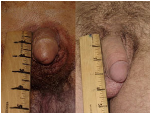 Penis Lengthening Enlargement Surgery, Penis Enlargement, Larger Penis, Penis Enlargement Surgery India