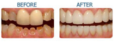 Cosmetic Dentistry India, Dental Surgeon India,Affordable Dentistry India, Dental Implant India