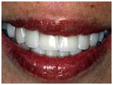 Dental Crowns India, Dental Crowns, India Dental Crowns Hospital, Cosmetic Dentistry India