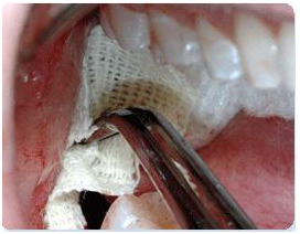 Dental Extraction India, Cost Dental Extraction, Dental India, Low Cost Dental Extraction Mumbai India