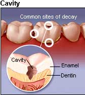 Dental Filling India, Cost Dental Cavity Fillings India, Mercury Fillings