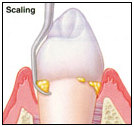 Dental Teeth Scaling India, Cost Dental Scaling Hospital India, Dental Ultrasonic Scaling