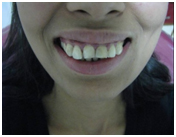 Laser Dentistry Treatment India, Cost Laser Dentistry Hospital India, Dental Laser Treatment