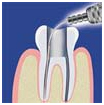 Dental Laser Treatment, Laser Dental Clinic In India, Laser Root Canal Treatment