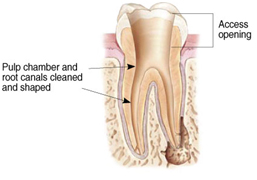 Root Canal Treatment India, Cost Root Canal Treatment Hospital India
