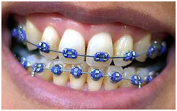 Invisible Braces, Dental Implants, Braces (Orthodontic Treatment) Services, Invisible Orthodontics, Tourism