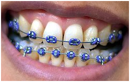 Braces apply continuous Braces For Teeth Design