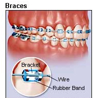 Dental, Treatment, Invisible Braces, Dentist, India