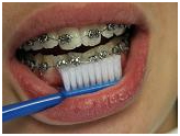Orthodontists Dental Braces, Dental, Treatment, Braces (Orthodontic Treatment) Services, Dentist, India