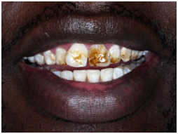 teeth whitening cost dentist, human teeth diagram molars