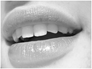 Porcelain Veneers Treatment India, Cost Porcelain Veneers Treatment