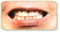 Porcelain Veneers Treatment India,  Porcelain Veneers Treatment  India, Porcelain Veneers Treatment  Hospital Delhi