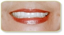 Cost Porcelain Veneers Treatment,  Low Cost Porcelain Veneers Treatment  Delhi India