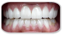 Porcelain Veneers Treatment India, Cost Porcelain Veneers Treatment,  Porcelain Veneers Treatment  India, Porcelain Veneers Treatment  Hospital Delhi