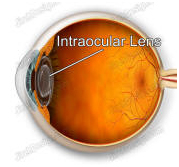 IOL, Intraocular Lens Implantation, Intraocular Lens, India Hospital Tour