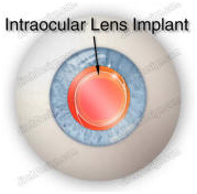 Intraocular Lens Implant, Intraocular Lens, India Hospital Tour