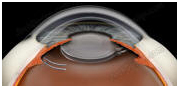 Intraocular Lens Implant, Intraocular Lenses, Intraocular Lens Implantation, Intraocular Lens
